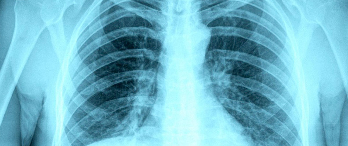 Tuberculosis (TB) Anova Health Institute
